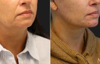 50 year-old before and 3 months after a facelift, neck lift, fat grafting to the face, and a TCA peel