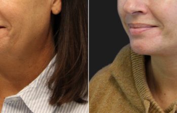 50 year-old before and 3 months after a facelift, neck lift, fat grafting to the face, and a TCA peel