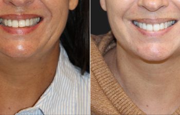 50 year-old before and 3 months after a facelift, neck lift, fat grafting to the face, and a TCA peel