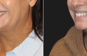 50 year-old before and 3 months after a facelift, neck lift, fat grafting to the face, and a TCA peel