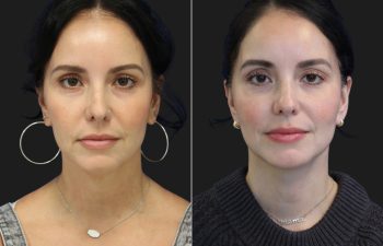 49 year-old patient before and 4 months post-op mini facelift and neck lift