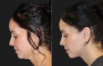 49 year-old patient before and 4 months post-op mini facelift and neck lift