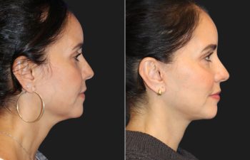 49 year-old patient before and 4 months post-op mini facelift and neck lift