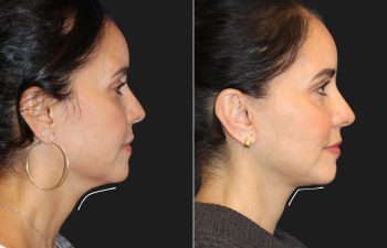 49 year-old patient before and 4 months post-op mini facelift and neck lift