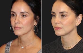 49 year-old patient before and 4 months post-op mini facelift and neck lift