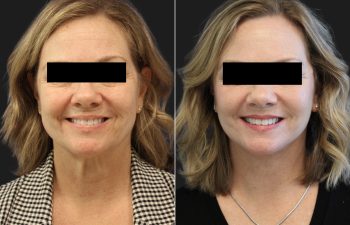 64 year-old before and 2 months after a Facelift, Neck Lift, Lower Blepharoplasty, Fat grafting to the Face, and Buccal Fat Pad Removal