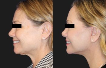 64 year-old before and 2 months after a Facelift, Neck Lift, Lower Blepharoplasty, Fat grafting to the Face, and Buccal Fat Pad Removal