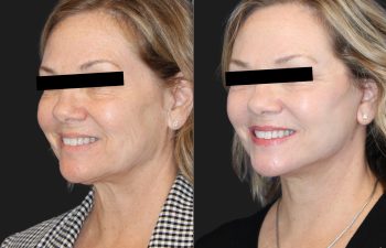 64 year-old before and 2 months after a Facelift, Neck Lift, Lower Blepharoplasty, Fat grafting to the Face, and Buccal Fat Pad Removal