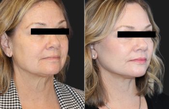 64 year-old before and 2 months after a Facelift, Neck Lift, Lower Blepharoplasty, Fat grafting to the Face, and Buccal Fat Pad Removal