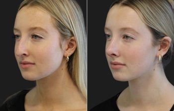 17 year-old patient before and 7 weeks after rhinoplasty