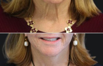 64 year-old patient before after facelift, neck lift, lower and upper blepharoplasty, canthopexy, CO2 laser