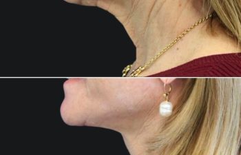 64 year-old patient before after facelift, neck lift, lower and upper blepharoplasty, canthopexy, CO2 laser