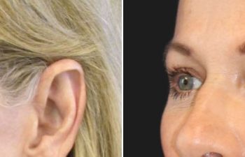 67 year-old before and after a facelift, neck lift, upper and lower blepharoplasty, brow lift, facial fat grafting, TCA Peel and skincare treatment