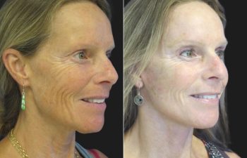 59 year-old before and 4 weeks after a facelift, neck lift, upper blepharoplasty, brow lift, facial fat grafting, TCA Peel and skincare treatment.