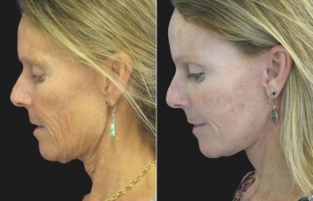 59 year-old before and 4 weeks after a facelift, neck lift, upper blepharoplasty, brow lift, facial fat grafting, TCA Peel and skincare treatment.
