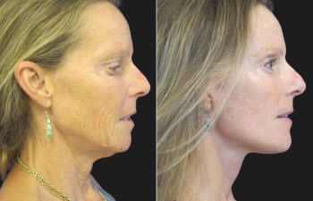 59 year-old before and 4 weeks after a facelift, neck lift, upper blepharoplasty, brow lift, facial fat grafting, TCA Peel and skincare treatment.