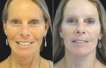 59 year-old before and 4 weeks after a facelift, neck lift, upper blepharoplasty, brow lift, facial fat grafting, TCA Peel and skincare treatment.