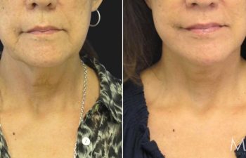 65 year-old before and after a facelift, neck lift, lower blepharoplasty, facial fat grafting, TCA Peel and medical-grade skincare treatment.