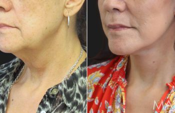 65 year-old before and after a facelift, neck lift, lower blepharoplasty, facial fat grafting, TCA Peel and medical-grade skincare treatment.