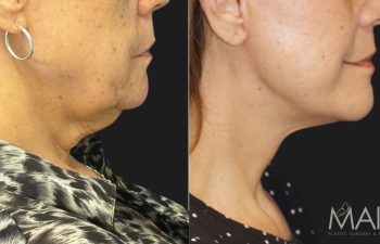 65 year-old before and after a facelift, neck lift, lower blepharoplasty, facial fat grafting, TCA Peel and medical-grade skincare treatment.