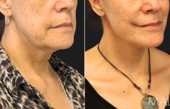 65 year-old before and after a facelift, neck lift, lower blepharoplasty, facial fat grafting, TCA Peel and medical-grade skincare treatment.