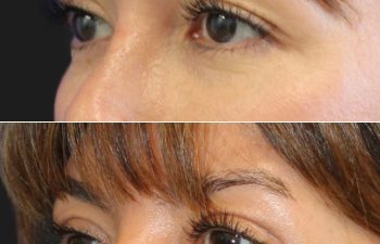 50 year-old patient before and 2 months after facelift, neck lift, and upper blepharoplasty