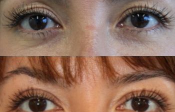 50 year-old patient before and 2 months after facelift, neck lift, and upper blepharoplasty