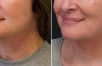 49 year-old patient before and after face lift, neck lift, upper blepharoplasty, fat grafting to the face, and a TCA peel