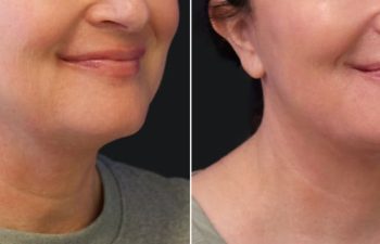 49 year-old patient before and after face lift, neck lift, upper blepharoplasty, fat grafting to the face, and a TCA peel