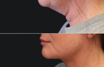 49 year-old patient before and after face lift, neck lift, upper blepharoplasty, fat grafting to the face, and a TCA peel