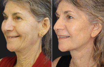 65 year-old before and 6 weeks after a facelift, neck lift, and TCA peel