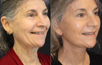65 year-old before and 6 weeks after a facelift, neck lift, and TCA peel