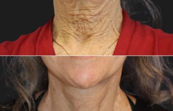 65 year-old before and 6 weeks after a facelift, neck lift, and TCA peel