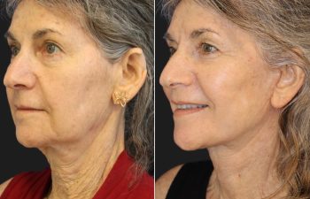65 year-old before and 6 weeks after a facelift, neck lift, and TCA peel