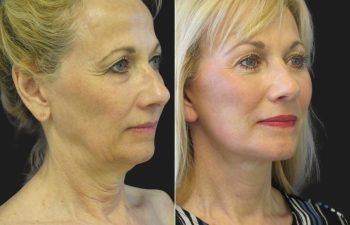 67 year-old before and after a facelift, neck lift, upper and lower blepharoplasty, brow lift, facial fat grafting, TCA Peel and skincare treatment
