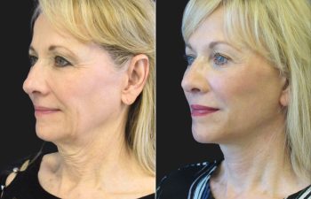 67 year-old before and after a facelift, neck lift, upper and lower blepharoplasty, brow lift, facial fat grafting, TCA Peel and skincare treatment