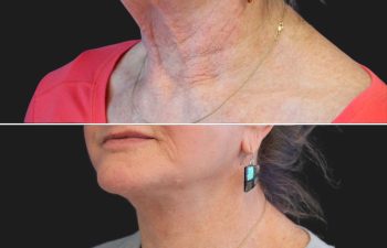 70 year-old patient before and after facelift, neck lift, lower and upper blepharoplasty, brow lift, canthopexy, fat grafting, lip lift, lip filler, and CO2 laser
