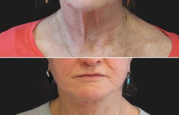 70 year-old patient before and after facelift, neck lift, lower and upper blepharoplasty, brow lift, canthopexy, fat grafting, lip lift, lip filler, and CO2 laser