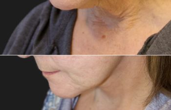 68 year-old before and 7.5 weeks after a facelift, neck lift, facial fat grafting, and TCA peel