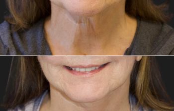 68 year-old before and 7.5 weeks after a facelift, neck lift, facial fat grafting, and TCA peel