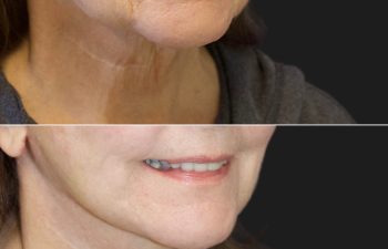 68 year-old before and 7.5 weeks after a facelift, neck lift, facial fat grafting, and TCA peel