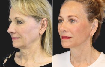67 year-old before and after a facelift, neck lift, upper and lower blepharoplasty, brow lift, facial fat grafting, TCA Peel and skincare treatment