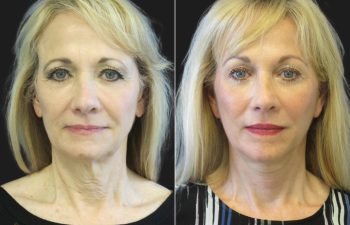 67 year-old before and after a facelift, neck lift, upper and lower blepharoplasty, brow lift, facial fat grafting, TCA Peel and skincare treatment