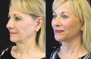 67 year-old before and after a facelift, neck lift, upper and lower blepharoplasty, brow lift, facial fat grafting, TCA Peel and skincare treatment