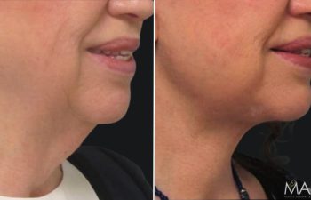 Patient before and after facelift and neck lift