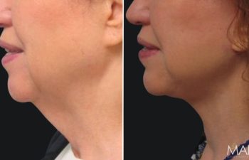 Patient before and after facelift and neck lift