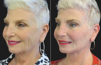 59 year-old facelift, neck lift, upper and lower blepharoplasty, brow lift, facial fat grafting, CO2 Laser, and skincare treatment.