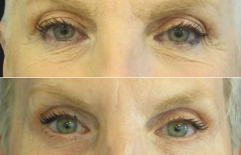 59 year-old facelift, neck lift, upper and lower blepharoplasty, brow lift, facial fat grafting, CO2 Laser, and skincare treatment.