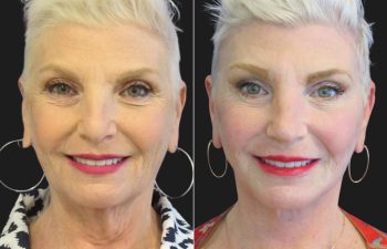 59 year-old facelift, neck lift, upper and lower blepharoplasty, brow lift, facial fat grafting, CO2 Laser, and skincare treatment.