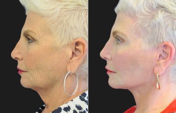 59 year-old facelift, neck lift, upper and lower blepharoplasty, brow lift, facial fat grafting, CO2 Laser, and skincare treatment.